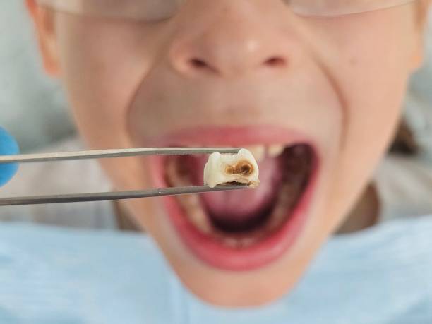 Best Emergency Tooth Extraction in Jersey Village, TX